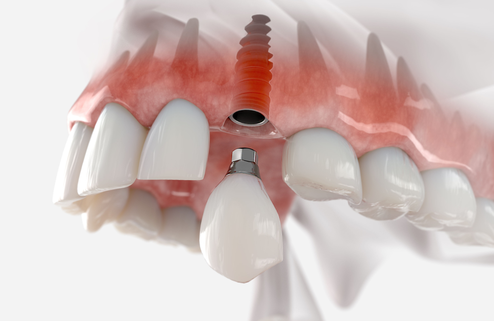 Teeth Implants St. John, MO | Local Teeth Restoration Dentists